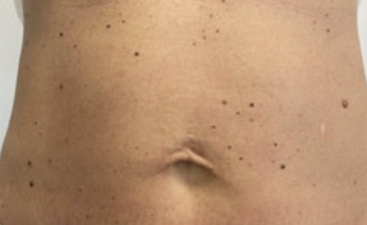 Dopo — Endolift addome