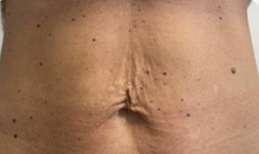 Prima — Endolift addome