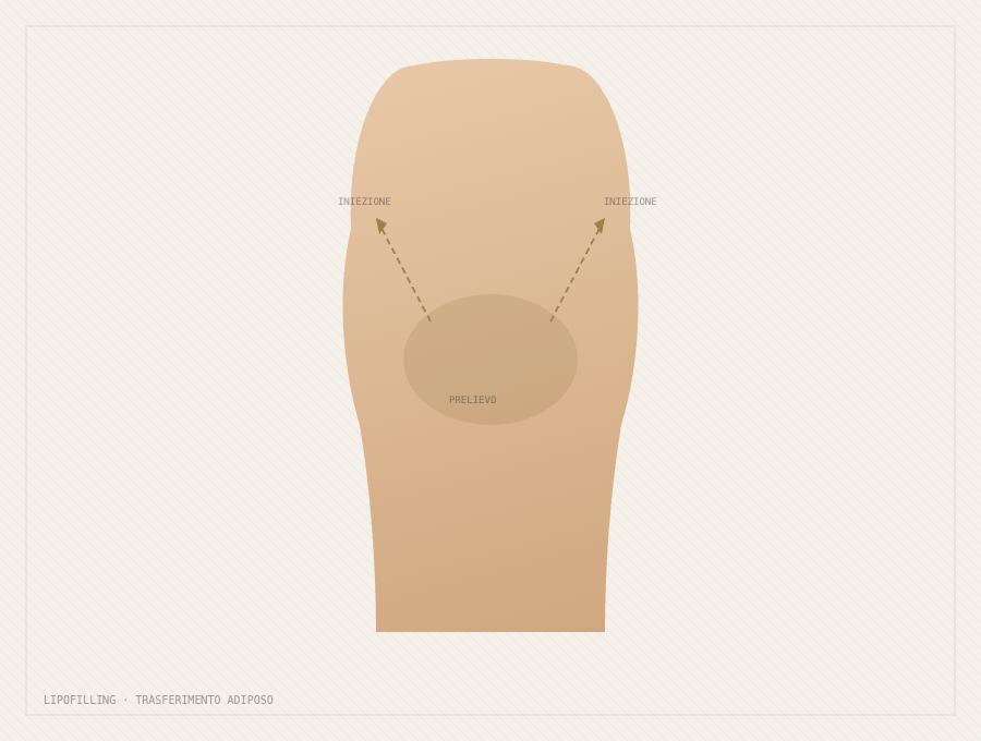 lipofilling