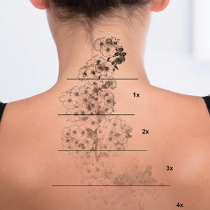 Rimozione tatuaggi laser – Dr. Elsharkawy, Verbania