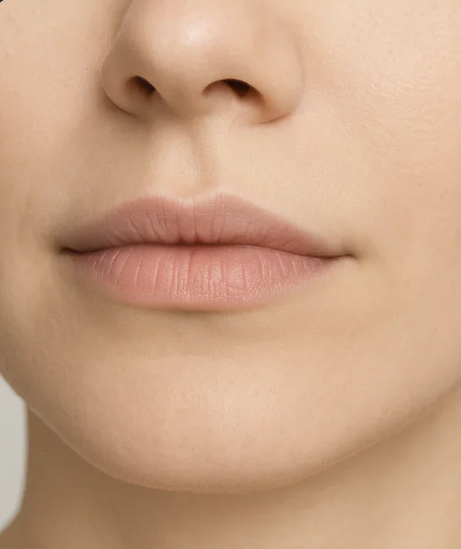 Filler labbra — prima