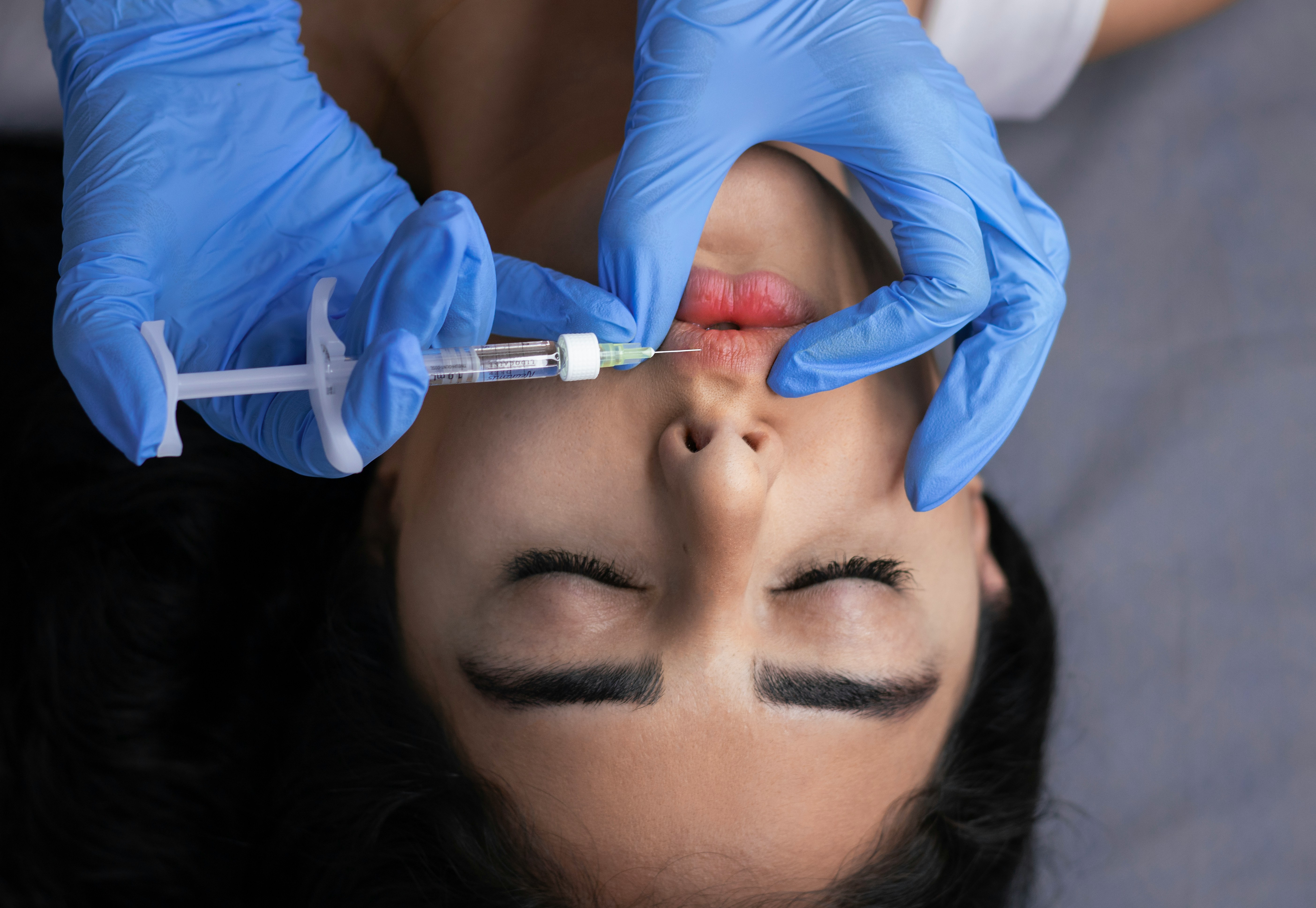Filler labbra — iniezione clinica