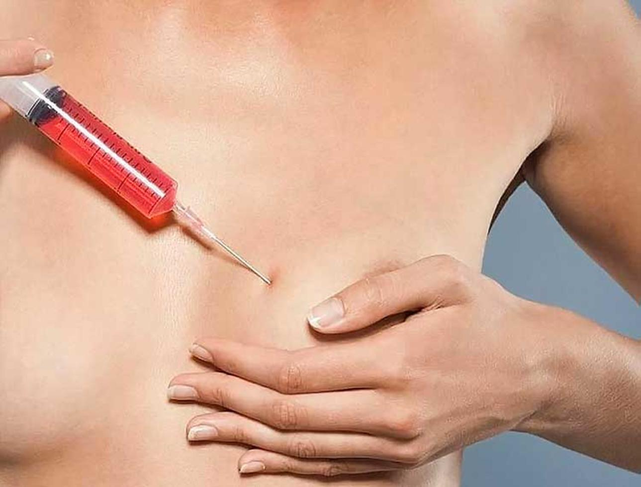 Lipofilling — iniezione di grasso autologo